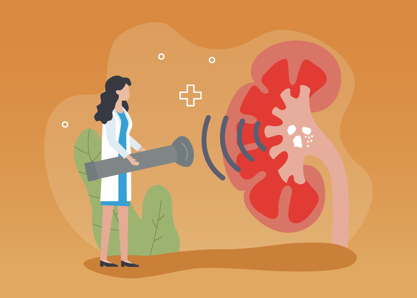 Kidney Stone Treatments 101: Extracorporeal Shock Wave Lithotripsy (ESWL) 