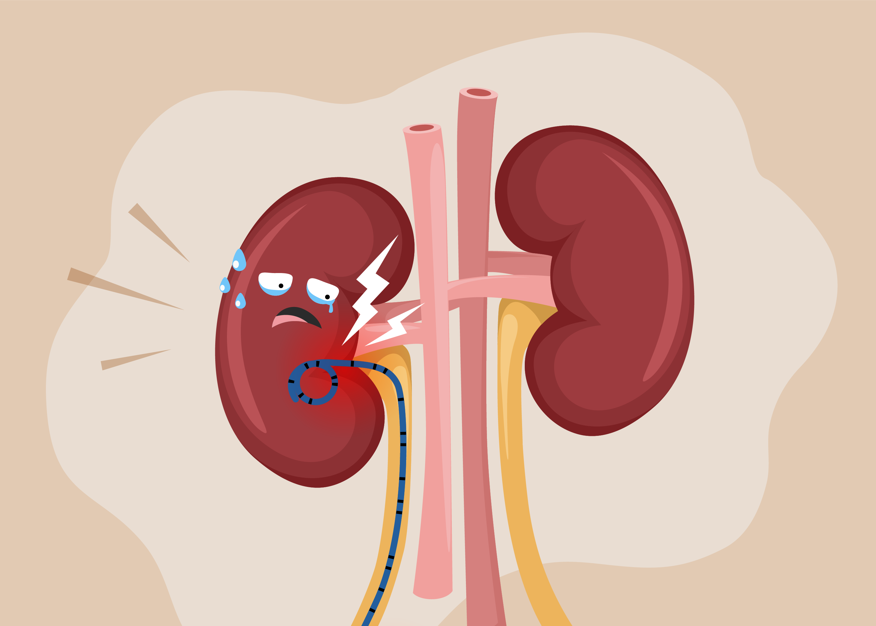 stent-for-kidney-stone